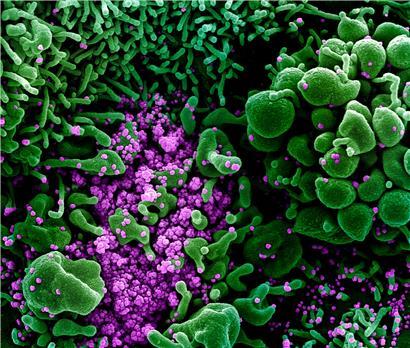 Auf dieser vom US-Forschungszentrum «National Institute of Allergy and Infectious Diseases» (NIAID) zur Verfügung gestellten Aufnahme vom 13.02.2020 ist eine Zelle (grün) mit dem Coronavirus (SARS-CoV-2, violett) infiziert.
