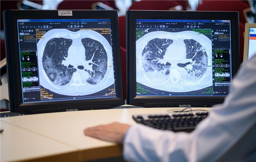 Auf zwei Monitoren sind am Klinikum Stuttgart Computertomographieaufnahmen der Lunge eines Covid-19-Patienten zu sehen. Die linke Aufnahme wurde zu Beginn der Behandlung der Coronainfektion angefertigt – die rechte Aufnahme 13 Tage später. Die Ausbreitung der weißen Bereiche in der rechten Aufnahme zeigen eine stärke Infektion mit Wassereinlagerungen in der Lunge. 
