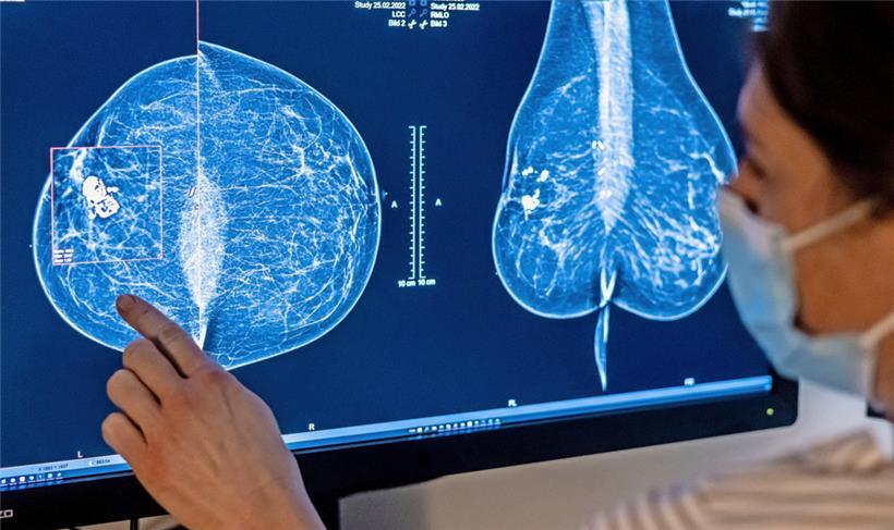 Bei einer Mammografie kann Brustkrebs schon früh erkannt werden
