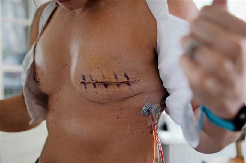 Bei einer vollständigen Mastektomie werden Hautmantel, Brustdrüse und Brustwarze entfernt
