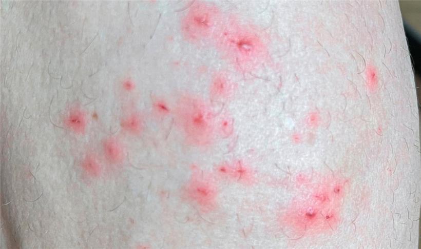 Das vom „Institute of Tropical Medicine Antwerp“ zur Verfügung gestellte Foto zeigt Hautsymptome von Affenpocken-Patienten. Die Zahl der Affenpocken-Nachweise steigt in aller Welt.
