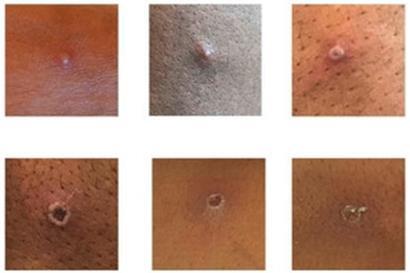 Das von der UK Health Security Agency (UKHSA) zur Verfügung gestellte Bild zeigt Hautläsionen bei Patienten, bei denen Affenpocken nachgewiesen wurden
