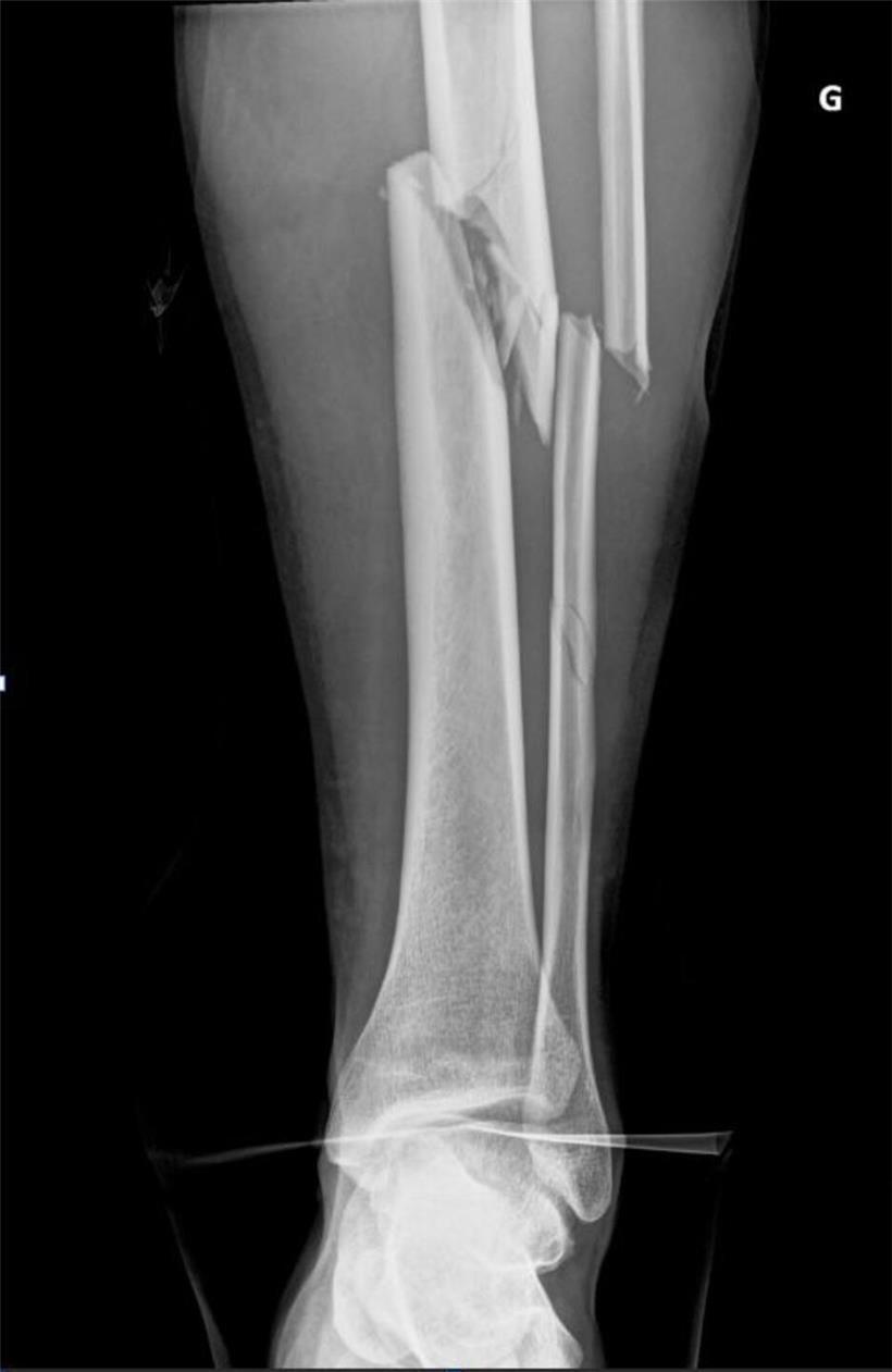 Röntgenbild von Schienbein- und Wadenbeinbruch bei Unfall mit sichtbarem Knochenbruch und Frakturstellen