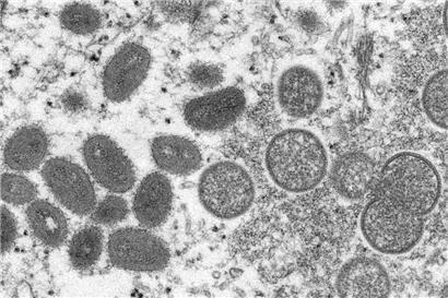 Diese elektronenmikroskopische Aufnahme aus dem Jahr 2003, die von den „Centers for Disease Control and Prevention“ zur Verfügung gestellt wurde, zeigt reife, ovale Affenpockenviren (l.) und kugelförmige unreife Virionen (r.), die aus einer menschlichen Hautprobe im Zusammenhang mit dem Präriehundeausbruch von 2003 stammt
