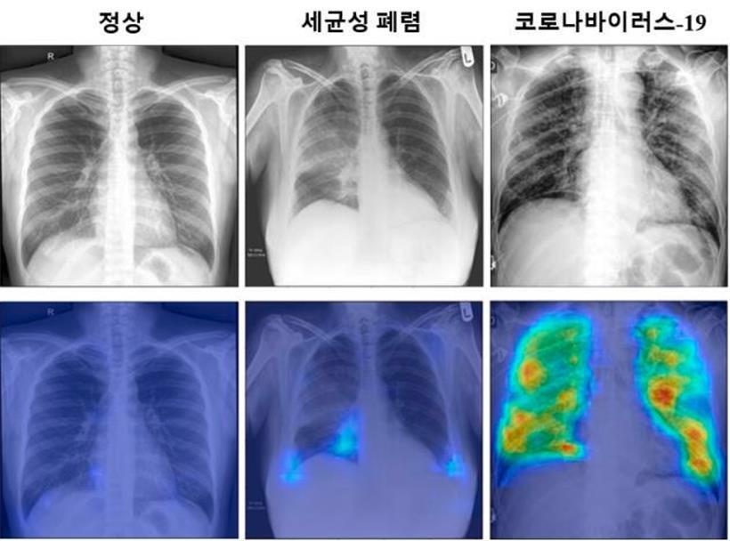 Dieses zusammengesetzte Foto, das vom Korea Advanced Institute of Science and Technology (KAIST) zur Verfügung gestellt wurde, zeigt Röntgenaufnahmen, die von Röntgenstrahlen mithilfe künstlicher Intelligenz aufgenommen wurden. Die linke Spalte zeigt den Normalzustand der Lunge, die mittlere eine bakterielle Lungenentzündung und die rechte eine Covid-19-Infektion.
