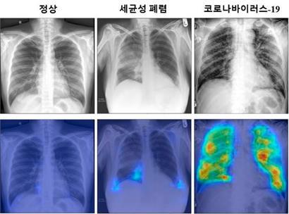 Dieses zusammengesetzte Foto, das vom Korea Advanced Institute of Science and Technology (KAIST) zur Verfügung gestellt wurde, zeigt Röntgenaufnahmen, die von Röntgenstrahlen mithilfe künstlicher Intelligenz aufgenommen wurden. Die linke Spalte zeigt den Normalzustand der Lunge, die mittlere eine bakterielle Lungenentzündung und die rechte eine Covid-19-Infektion.
