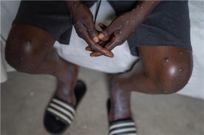 Ein nicht identifizierter, mit Mpox infizierter, Mann sitzt im Allgemeinen Krankenhaus von Goma, wo er weiter behandelt wird
