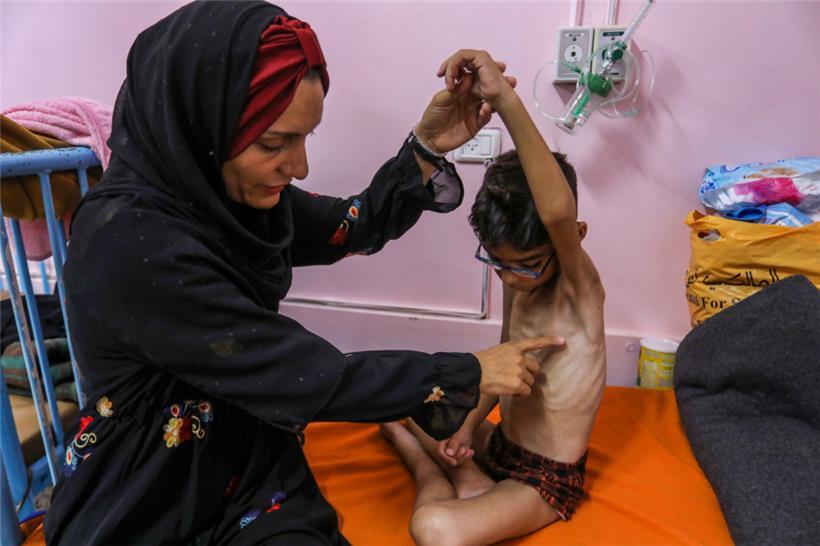 Ein palästinensisches Kind, das an schwerer Unterernährung leidet
