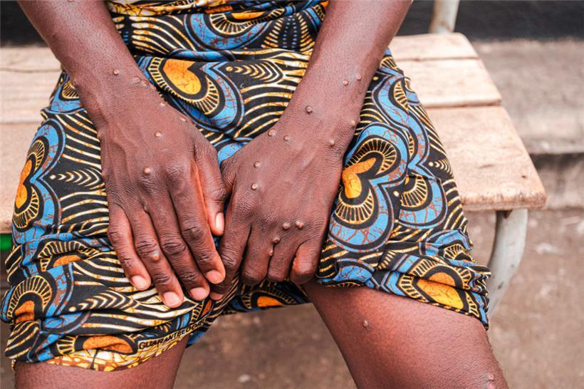 Eine mit Mpox infizierte Frau zeigt ihre Arme im Mpox-Behandlungszentrum des Universitätskrankenhauses Kamenge in Bujumbura
