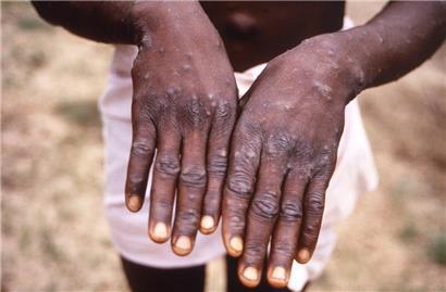 Eines der angeblich falschen Fotos, mit denen die Affenpocken-Epidemien „erfunden“ würden: Dieses Bild aus dem Jahr 1997, das von der CDC während einer Untersuchung eines Affenpocken-Ausbruchs in der Demokratischen Republik Kongo (DRC), dem früheren Zaire, zur Verfügung gestellt wurde, zeigt die Rückenflächen der Hände eines Affenpocken-Patienten, der den charakteristischen Ausschlag in der Erholungsphase zeigte. 
