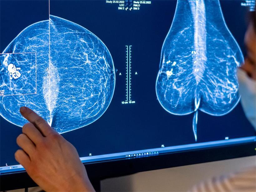 Medizinisches Personal untersucht mit einer Mammografie die Brust einer Frau auf Brustkrebs