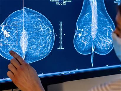 Medizinisches Personal untersucht mit einer Mammografie die Brust einer Frau auf Brustkrebs