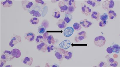 Naegleria fowleri  infiziert Menschen, in dem sie die Nase hinauf ins Hirn wandert. Dort konsumiert die Amöbe Hirngewebe. 
