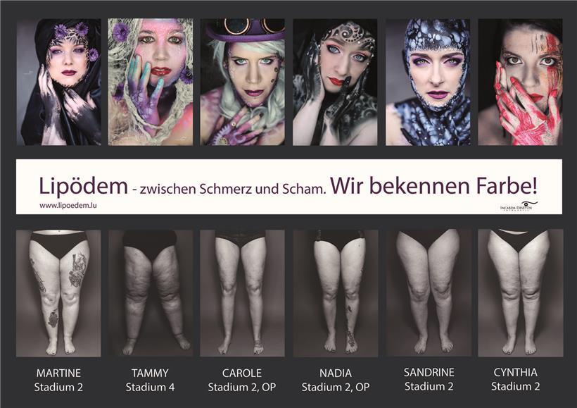 Frau mit Lipödem zeigt Scham und geringes Selbstwertgefühl wegen körperlicher Symptome der Krankheit