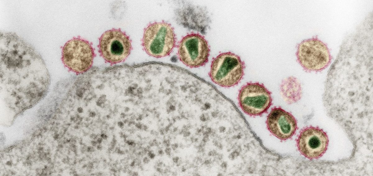 Erst zweiter Fall weltweit: HIV-Patient in London möglicherweise geheilt