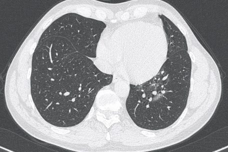 Röntgenaufnahme der Lunge eines Covid-19-Erkrankten.
