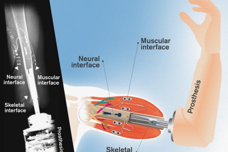 Die Prothese ist mit den Muskeln, den Nerven und dem Knochen ihres Trägers verbunden