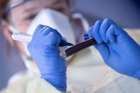 Studie / Blutgruppe beeinflusst Covid-19-Verlauf – Gesundheitsdirektion liegen keine Daten vor