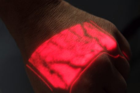 Der Venenscanner von „Abrigado“ im Einsatz