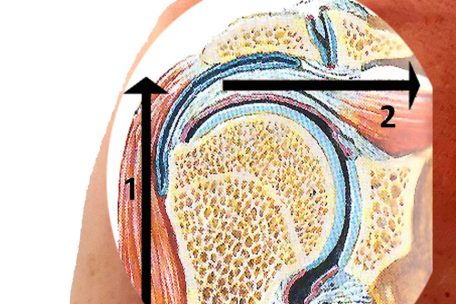 Die komplizierte Mechanik des Schultergelenks: Für die Abspreizbewegung sorgen der Deltamuskel (1) und der Supraspinatusmuskel (2)