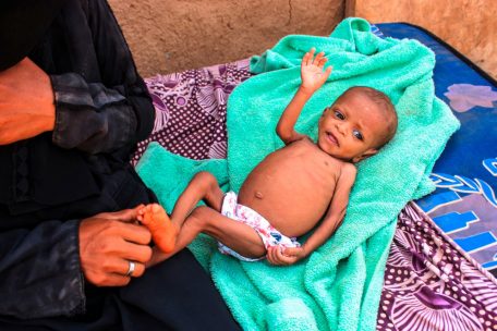 Der Krieg in der Ukraine steigert das Hungerproblem im Jemen