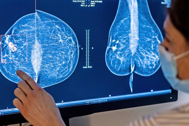 Luxemburg / Diagnose Brustkrebs: 2021 gab es 602 Rückerstattungen für Mastektomien