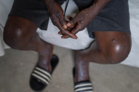 Krankheiten / Neue Mpox-Variante: Schweden meldet ersten Fall außerhalb Afrikas