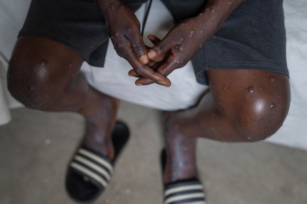 Krankheiten / Neue Mpox-Variante: Schweden meldet ersten Fall außerhalb Afrikas