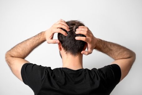 Jucken und Haarausfall / Kopfhautpilz taucht auch in Luxemburg auf