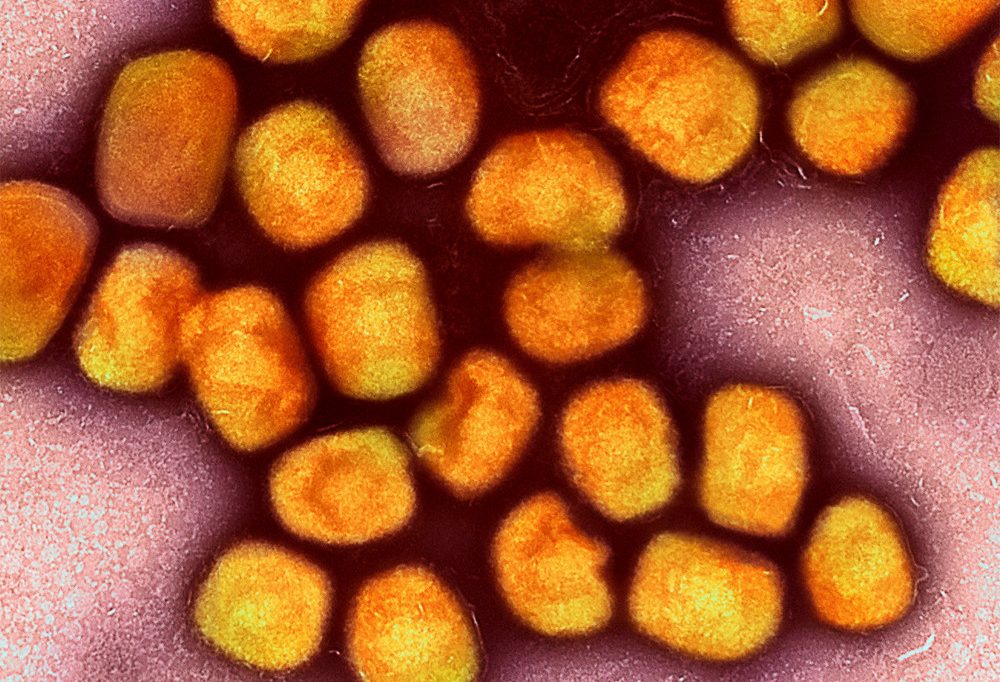 Deutschland / Erster Fall der neuen Mpox-Variante in Köln