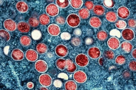 Großbritannien / WHO: Neue Mpox-Variante erstmals in Europa übertragen