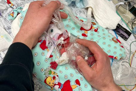 Deutschland / Winziges Baby kommt mit 265 Gramm zur Welt