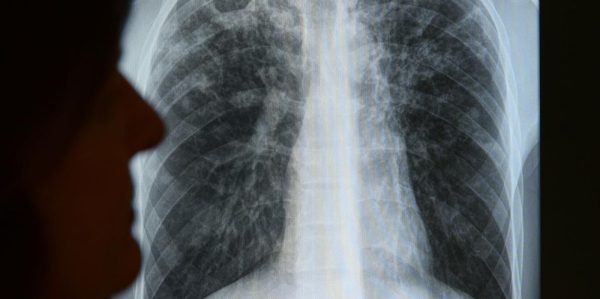 Mehrere Tuberkulose-Fälle in Trier