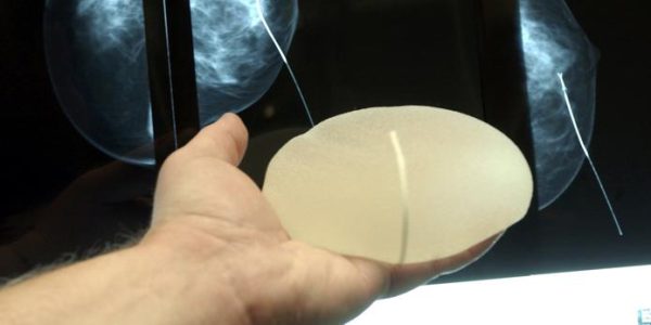 Ein Implantate-Register für alle Fälle
