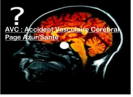 4 Accidents vasculaires cérébraux par jour